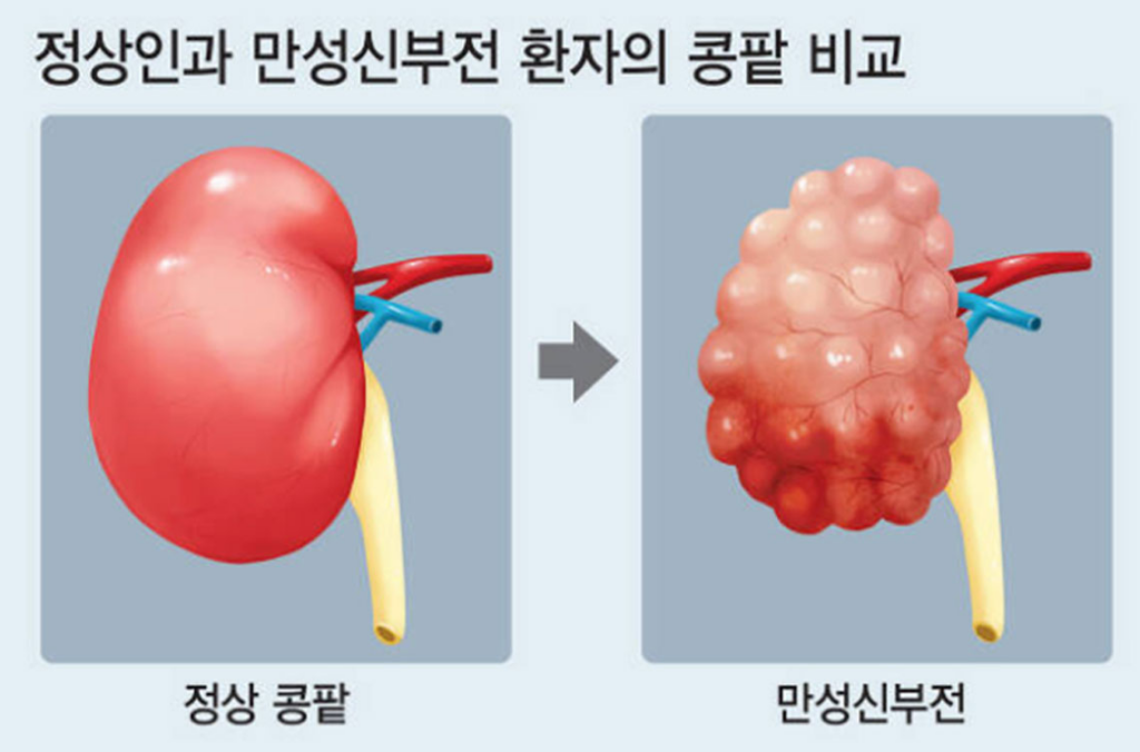 알스트롬 증후군