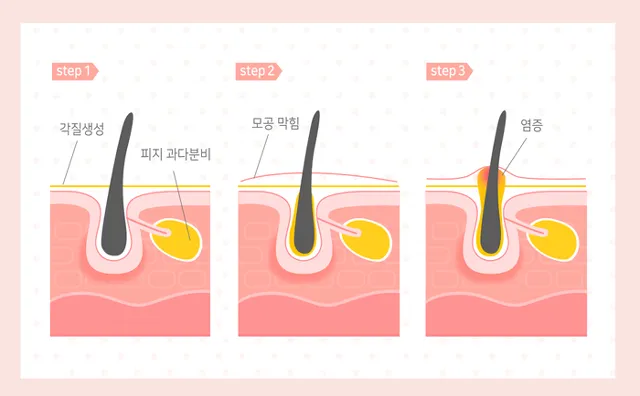 막힌 모공