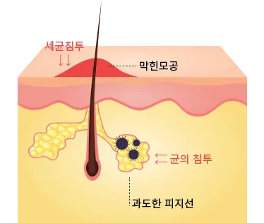 막힌 모공