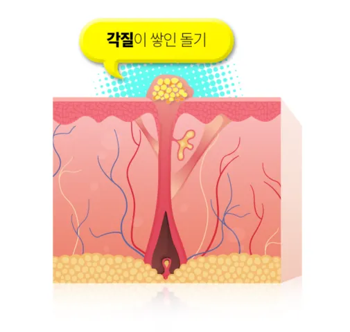 T존 모공