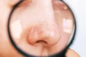열감