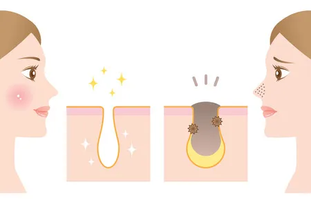 막힌 모공